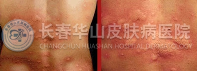 荨麻疹的症状