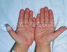 皮肤过敏症状图片