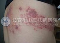 带状疱疹症状