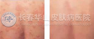 慢性荨麻疹治疗前后对比图