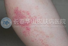 皮肤瘙痒的症状表现