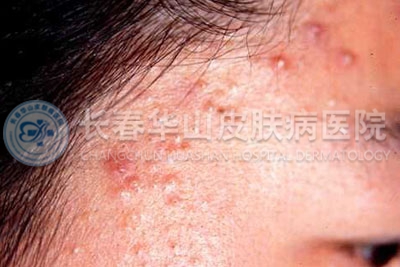 出现痤疮的原因