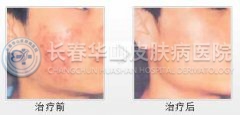青春痘在临床上有哪些表现症状?
