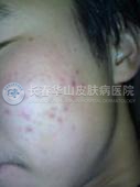痤疮复发