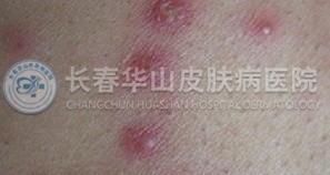 毛囊炎症状
