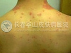 玫瑰糠疹的症状表现