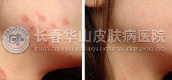玫瑰糠疹治愈案例