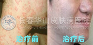 皮肤瘙痒症状图片