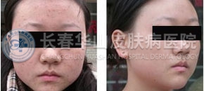 扁平疣治疗的前后对比图