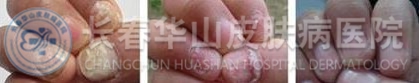 灰指甲治疗前中后对比图