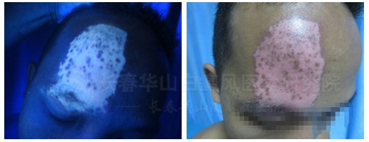 告别白癜风重新做回自己