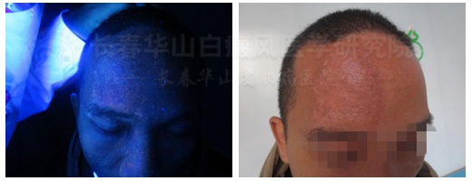 告别白癜风重新做回自己